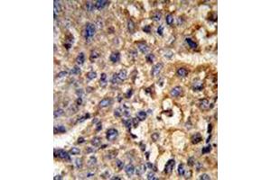 Formalin-fixed and paraffin-embedded human hepatocarcinoma reacted with 17-beta-HSD12 / HSD17B12 Antibody (Center) followed which was peroxidase-conjugated to the secondary antibody, followed by DAB staining. (HSD17B12 antibody  (Middle Region))