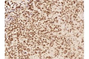 Paraformaldehyde-fixed, paraffin embedded Human neuroglioma; Antigen retrieval by boiling in sodium citrate buffer (pH6) for 15min; Block endogenous peroxidase by 3% hydrogen peroxide for 30 minutes; Blocking buffer (normal goat serum) at 37°C for 20min; Antibody incubation with C8orf58 Polyclonal Antibody, Unconjugated (bs-15297R) at 1:400 overnight at 4°C, followed by a conjugated secondary and DAB staining. (C8ORF58 antibody  (AA 251-365))