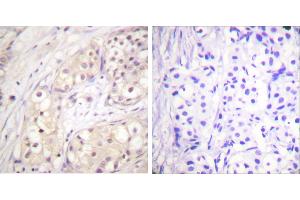 Peptide - +Immunohistochemistry analysis of paraffin-embedded human breast carcinoma tissue using B-Raf antibody. (SNRPE antibody  (Internal Region))