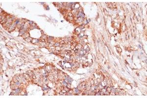 Immunohistochemistry of paraffin-embedded Human colon carcinoma using MAP2K3 Polyclonal Antibody at dilution of 1:100 (40x lens). (MAP2K3 antibody)