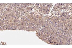 ABIN6278067 at 1/100 staining Human liver cancer tissue by IHC-P. (rala antibody  (C-Term))