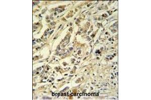 ASM3A Antibody (C-term) (ABIN651168 and ABIN2840109) IHC analysis in formalin fixed and paraffin embedded breast carcinoma followed by peroxidase conjugation of the secondary antibody and DAB staining. (SMPDL3A antibody  (C-Term))