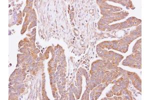 IHC-P Image Immunohistochemical analysis of paraffin-embedded human lung cancer, using C4orf19, antibody at 1:100 dilution. (C4orf19 antibody)