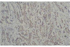 Immunohistochemistry of paraffin-embedded Human breast carcinoma tissue using TBP Monoclonal Antibody at dilution of 1:200. (TBP antibody)