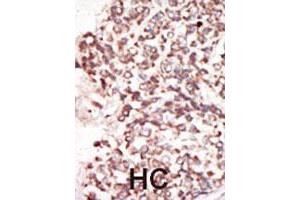 Formalin-fixed and paraffin-embedded human hepatocellular carcinoma tissue reacted with the PIM2 polyclonal antibody  , which was peroxidase-conjugated to the secondary antibody, followed by DAB staining. (PIM2 antibody  (C-Term))