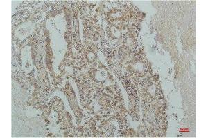 Immunohistochemical analysis of paraffin-embedded Human Lung Carcinoma using IκB β(mAb diluted at 1:200. (NFKBIB antibody)