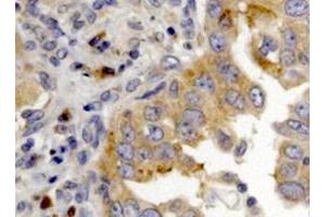 Dicer expression in lung tumor via R13D6 (DICER1 antibody)