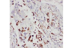 Anti-5 Lipoxygenase antibody, IHC(P) IHC(P): Human Lung Cancer Tissue (ALOX5 antibody  (C-Term))