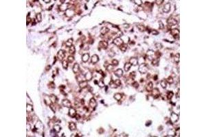 IHC analysis of FFPE human hepatocarcinoma stained with the CAMK2G antibody (CAMKII gamma antibody  (AA 309-338))