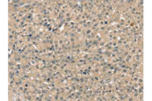 The image on the left is immunohistochemistry of paraffin-embedded Human breast cancer tissue using ABIN7192556(SMAGP Antibody) at dilution 1/40, on the right is treated with synthetic peptide. (SMAGP antibody)