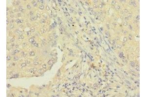 Immunohistochemistry of paraffin-embedded human lung cancer using ABIN7167385 at dilution of 1:100 (RAB8B antibody  (AA 15-204))