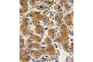Formalin-fixed and paraffin-embedded human hepatocarcinoma with COL6A1 Antibody , which was peroxidase-conjugated to the secondary antibody, followed by DAB staining.