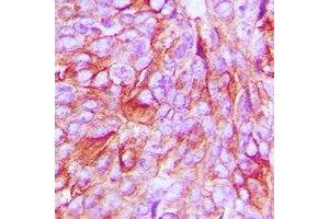 Immunohistochemical analysis of mPR alpha staining in human breast cancer formalin fixed paraffin embedded tissue section. (PAQR7 antibody  (C-Term))