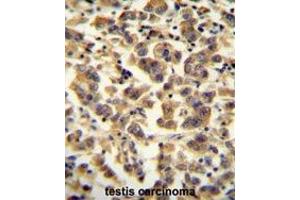 TTC39B antibody (C-term) immunohistochemistry analysis in formalin fixed and paraffin embedded human testis carcinoma followed by peroxidase conjugation of the secondary antibody and DAB staining. (TTC39B antibody  (C-Term))