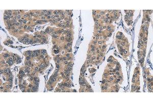 Immunohistochemistry of paraffin-embedded Human breast cancer tissue using DSG2 Polyclonal Antibody at dilution 1:50 (Desmoglein 2 antibody)