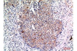 Immunohistochemistry (IHC) analysis of paraffin-embedded Human Breast Cancer, antibody was diluted at 1:100. (MUC1 antibody  (Internal Region))