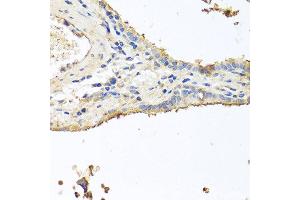 Immunohistochemistry of paraffin-embedded human lung cancer using INS antibody at dilution of 1:100 (40x lens). (Insulin antibody)