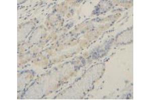 Detection of MMP2 in Human Stomach Cancer Tissue using Polyclonal Antibody to Matrix Metalloproteinase 2 (MMP2) (MMP2 antibody  (AA 445-660))