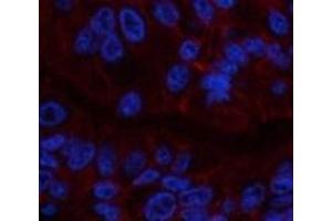 Immunofluorescence analysis of Human liver cancer tissue using CA9 Monoclonal Antibody at dilution of 1:200. (CA9 antibody)