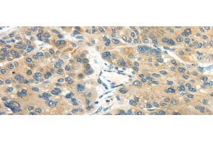 Immunohistochemistry of paraffin-embedded Human liver cancer tissue using CD70 Polyclonal Antibody at dilution 1:40 (CD70 antibody)