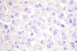 Immunohistochemistryanalysis of E-cadherin (pArg868) Antibody in paraffin-embedded human breast carcinoma tissue. (E-cadherin antibody)