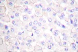 Immunohistochemistryanalysis of E-cadherin (pArg868) Antibody in paraffin-embedded human breast carcinoma tissue. (E-cadherin antibody)