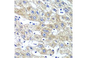 Immunohistochemistry of paraffin-embedded human liver injury using QARS antibody (ABIN5974184) at dilution of 1/100 (40x lens).