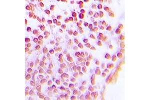 Immunohistochemical analysis of SIRT1 staining in human lung cancer formalin fixed paraffin embedded tissue section. (SIRT1 antibody)