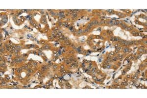 Immunohistochemistry of paraffin-embedded Human thyroid cancer using ADCY3 Polyclonal Antibody at dilution of 1:50 (ADCY3 antibody)