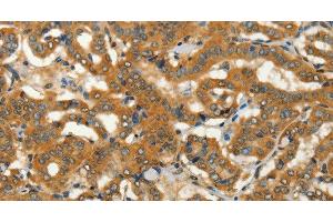 Immunohistochemistry of paraffin-embedded Human thyroid cancer using ADCY3 Polyclonal Antibody at dilution of 1:50