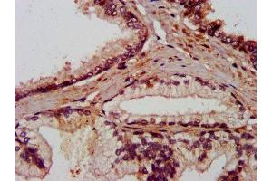 IHC image of ABIN7144036 diluted at 1:800 and staining in paraffin-embedded human prostate cancer performed on a Leica BondTM system. (AMIGO2 antibody  (AA 420-522))
