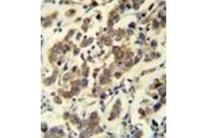Immunohistochemistry analysis in formalin fixed and paraffin embedded human testis carcinoma reacted with MBD3L3 Antibody (C-term) followed which was peroxidase conjugated to the secondary antibody and followed by DAB staining. (MBD3L3 antibody  (C-Term))
