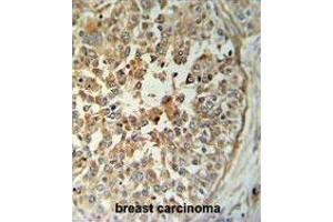 TM173 Antibody (C-term) IHC analysis in formalin fixed and paraffin embedded breast carcinoma followed by peroxidase conjugation of the secondary antibody and DAB staining. (STING/TMEM173 antibody  (C-Term))