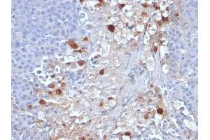 Formalin-fixed, paraffin-embedded human Melanoma stained with MCAM Mouse Monoclonal Antibody (MCAM/1101). (MCAM antibody)