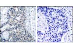 Immunohistochemistry analysis of paraffin-embedded human breast carcinoma, using Stathmin 1 (Phospho-Ser37) Antibody. (Stathmin 1 antibody  (pSer38))