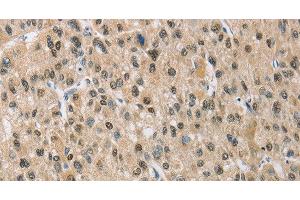 Immunohistochemistry of paraffin-embedded Human liver cancer using NAPSA Polyclonal Antibody at dilution of 1:50 (NAPSA antibody)