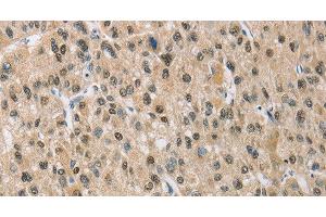 Immunohistochemistry of paraffin-embedded Human liver cancer using NAPSA Polyclonal Antibody at dilution of 1:50