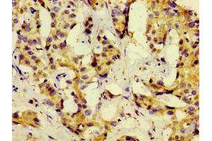 Immunohistochemistry of paraffin-embedded human liver cancer using ABIN7159562 at dilution of 1:100 (KISS1 antibody  (AA 20-138))