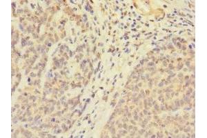 Immunohistochemistry of paraffin-embedded human ovarian cancer using ABIN7174603 at dilution of 1:100 (UBXN8 antibody  (AA 55-270))