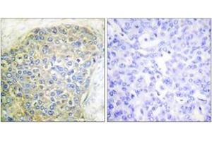 Immunohistochemistry analysis of paraffin-embedded human breast carcinoma tissue, using HSL (Ab-554) Antibody. (LIPE antibody  (AA 520-569))