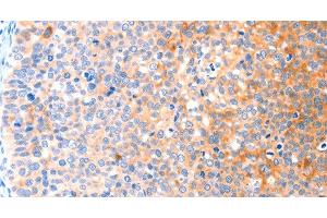Immunohistochemistry of paraffin-embedded Human cervical cancer tissue using CCDC88A Polyclonal Antibody at dilution 1:50