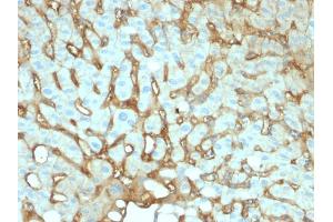 Formalin-fixed, paraffin-embedded human Hepatocellular Carcinoma stained with Albumin Mouse Monoclonal Antibody (ALB/2141). (Albumin antibody)