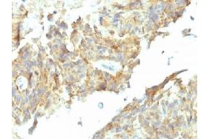 IHC testing of FFPE human ovarian carcinoma with Alkaline Phosphatase antibody (ALPL/597). (Alkaline Phosphatase antibody)
