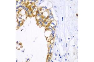 Immunohistochemistry of paraffin-embedded human liver cancer using BCL2 antibody.