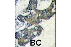 Forlin-fixed and paraffin-embedded hun breast carcino tissue reacted with PK1 Antibody (C-term) (ABIN1882175 and ABIN2841383) , which was peroxidase-conjugated to the secondary antibody, followed by DAB staining. (ERK2 antibody  (C-Term))