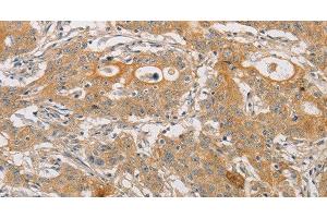 Immunohistochemistry of paraffin-embedded Human gasrtic cancer tissue using ARSK Polyclonal Antibody at dilution 1:30 (Arylsulfatase K antibody)