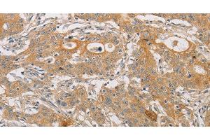 Immunohistochemistry of paraffin-embedded Human gasrtic cancer tissue using ARSK Polyclonal Antibody at dilution 1:30