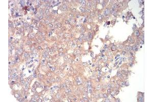 Immunohistochemical analysis of paraffin-embedded endometrial cancer tissues using mTOR mouse mAb with DAB staining. (MTOR antibody  (AA 2311-2529))