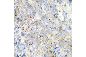 Immunohistochemistry of paraffin-embedded human esophageal cancer using PRKCQ antibody (ABIN5975395) at dilution of 1/200 (40x lens). (PKC theta antibody)