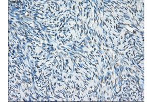 Immunohistochemical staining of paraffin-embedded Carcinoma of thyroid tissue using anti-PORmouse monoclonal antibody. (POR antibody)